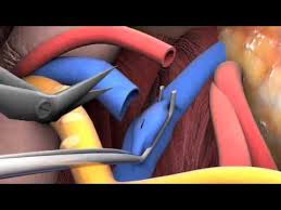 Lecture 2 6 Kidney Transplant Surgery Youtube