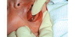 Tongue Tie The Royal Women S Hospital