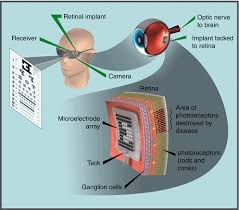 According to schedule the implants in the first series had to be removed after 30 days and after 3 month for the last 3 patients. Epiretinal Prosthesis Springerlink