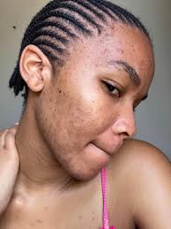 Cuticura Bar Soap Good for Acne