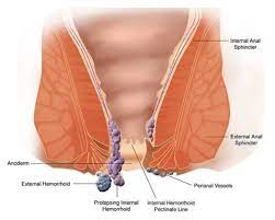 Here's why ingrown hairs form and how you can get rid of what is an ingrown hair? Anorectal Disorders A Pain In The Rear Emergency Medicine Board Review