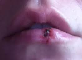 When you get a swollen busted lip, it's important to get it taken care of and treated! Underdogs Broken Girl