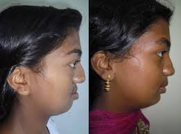 Retrognathic Maxilla Jaw Surgery Cleft Lip And Palate Maxillary Surgery
