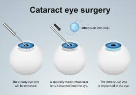 Image result for Cataract Extraction