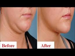 How To Get Rid Of Double Chin Permanently In 2 Months Without Surgery 100 Effective Youtube Double Chin Double Chin Treatment Double Chin Exercises