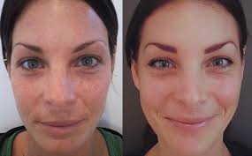 These acids are derived from plants and fruits and work to gently dissolve dead skin cells. Peel Away Imperfections All You Need To Know On Chemical Peels Joules Medspa Laser Center Apple Valley Mn