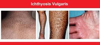 Image result for Ichthyosis