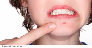 Pickel an der lippen werden unterschiedlich eingeschätzt und haben verschiedene ursachen. Was Hilft Gegen Pickel