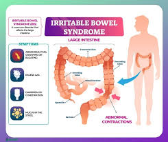 A doctor will answer in minutes. Irritable Bowel Syndrome Ibs Symptoms Causes Risk Groups Ibs Treatment And Ibs Diet Ecosh Life