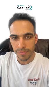 A 3 MESES DE SU IMPLANTE CAPILAR! , Nuestro paciente Federico Mazuchelli ya  está viendo grandes y notorios resultados! , Conoce su experiencia con  nosotros!, No esperés más para recuperar tu cabello!, ...