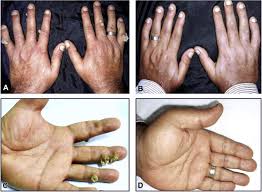 Recalcitrant cutaneous warts treated with recombinant quadrivalent human papillomavirus vaccine (types spontaneous remission of recalcitrant warts in girls after human papillomavirus vaccination. Intralesional Versus Intramuscular Bivalent Human Papillomavirus Vaccine In The Treatment Of Recalcitrant Common Warts Sciencedirect