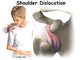 Image result for Chronic Shoulder Dislocation