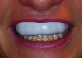 Soak it in the solution overnight for best results. Sports Mouthguards