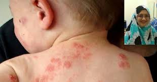 Ekzema adalah simptom keradangan dan kegatalan kulit. Doktor Sarankan Buat Ujian Darah Untuk Tahu Masalah Alahan Punca Anak Ekzema Sebelum Rawatan Diberi Pa Ma