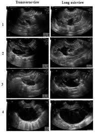 Fig 2 Postnatal Ultrasounds Depicting The Different Grades Of Hydronephrosis According To The Society Of Fetal Urology Sfu Class Ultrasound Sonography Fetal