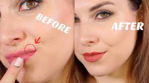 Read my story to see what worked and what changed my life. Top Proven Remedies To Get Rid Of Pimple On Lip Fastest Way