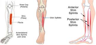 Shin splints typically develop after physical activity. Shin Splints Causes Symptoms How To Get Rid Of Shin Splints