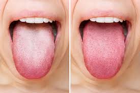 Image result for brown tongue symptoms