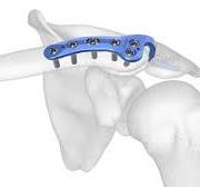 Clavicle Plating System | Acumed