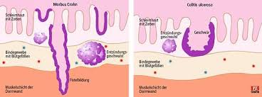 Im falle einer chronisch entzündlichen darmerkrankung (oder generell bei entzündungen im darm) ist dann eben viel calprotectin im darm bzw. Ced Bei Kindern Gegen Die Inflammation Im Darm Pz Pharmazeutische Zeitung
