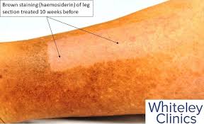 Image result for Pigment stains on the shin