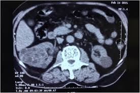 Draxol 400 mg film kapli tablet (24 film. Medical Treatment For An Isolated Renal Multilocular Hydatid Cyst In An Elderly A Case Report Bmc Nephrology Full Text