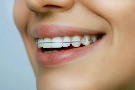 If you need a bottom teeth retainer as well as one for your top teeth, this could mean up to £800 in total. How Much Does A Retainer Cost Wild Smiles