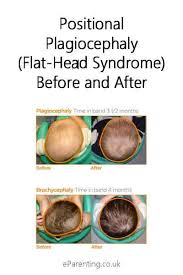 Image result for Positional Head Deformity