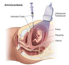 Image result for Fetal Testing Indications