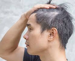 Hypothyroidism is different from hyperthyroidism, or an overactive thyroid, which occurs when your gland produces too much of the thyroid hormone. What Causes Gray Hair Below 30 5 Natural Remedies Mensopedia