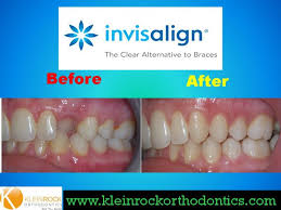 Maybe you would like to learn more about one of these? How To Fix A Crossbite With Invisalign