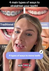 Straight Teeth Exercises