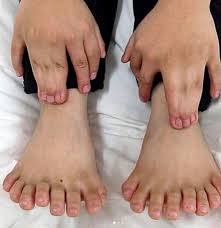 Image result for Supernumerary Digit