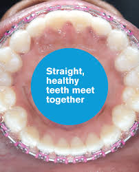 You should wear the bands every night until the gap is closed. Gaps Between Teeth Before And After Braces Viechnicki Orthodontics