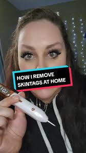 Skintag Removal at Home: Affordable Tips and Tricks