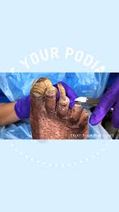Image result for Onychogryphosis feet