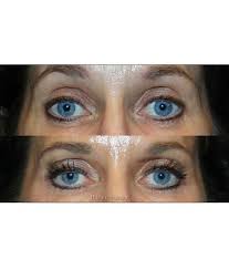February 27, 2016 blog author comments. Latisse 5ml Bimatoprost Ophthalmic Solution 0 03
