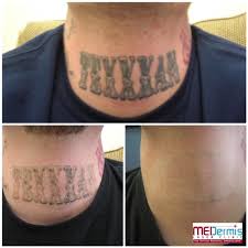 Tattoos that have not been effectively removed by other treatments or through home remedies may respond well to laser therapy providing the prior treatments did not result in excessive scarring. Neck Face Laser Tattoo Removal Before After Results Medermis