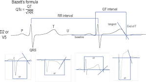Qt Interval Control To Prevent Torsades De Pointes During Use Of Hydroxychloroquine And Or Azithromycin In Patients With Covid 19