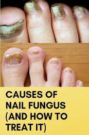 11 Most Popular Nail Fungus Acrylic Quotes Diy Nail Fungus Toenail Fungus Toenail Fungus Remedies