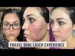 The fraxel laser is able to treat a variety of skin conditions. Pin On Fraxel Laser