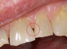 Cavities form when there is breakdown of the outer, calcified enamel of the tooth by bacteria commonly found in the human mouth. Tooth Decay Symptons Causes Treatment Nearby Dental