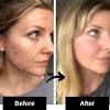 Nov 24, 2020 · while there's no real way to get rid of acne scars naturally and at home, there are a few things you can do to reduce your risk of getting acne scars: 1
