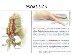 Image result for Psoas Sign
