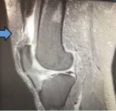 This section of the website will explain large and minute details of sagittal knee use the mouse scroll wheel to move the images up and down alternatively use the tiny arrows (>>) on both side of the image to move the images. Quadriceps Tendon Tear Missoula Bone Joint