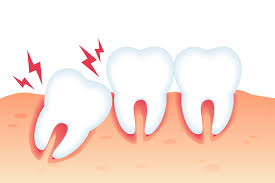 Can Invisalign Fix Snaggletooth- 2023 Invisalign'S Power