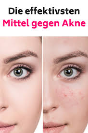 Akne Behandeln Akne Tipps Akne Narben Behandeln Akne Ernahrung Pickel Loswerden Pickel Hausmittel Pickel Soforthilfe Pickel Skin Care Health How To Make