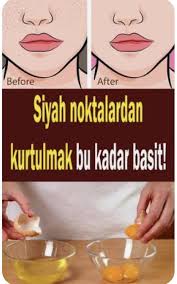 Siyah Noktalar Icin Maske Tarifleri Ve Dogal Oneriler Siyah Noktalar Siyah Lekeler Dogal