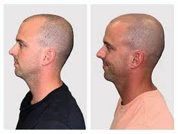 Scalp Micro Pigmentation | Micro Pigment Tattoo | The Landon Hair Clinic