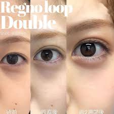 regno loop double法 クイックコスメティークダブルと同じ方法です ナチュラルに二重の幅を広げてぱっちりさせたい 299560 253230 モニター価格 湯澤医師指名多数の埋没法 埋没法で唯一当日から洗顔メイク可能 美容クリニック アイプチ メイク 美容整形